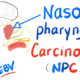 Symptoms of Nasopharyngeal Carcinoma