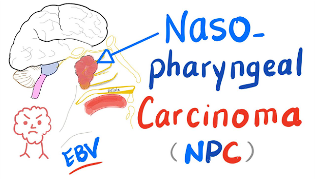 Symptoms of Nasopharyngeal Carcinoma