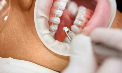 Ceramic Brackets