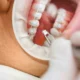 Ceramic Brackets