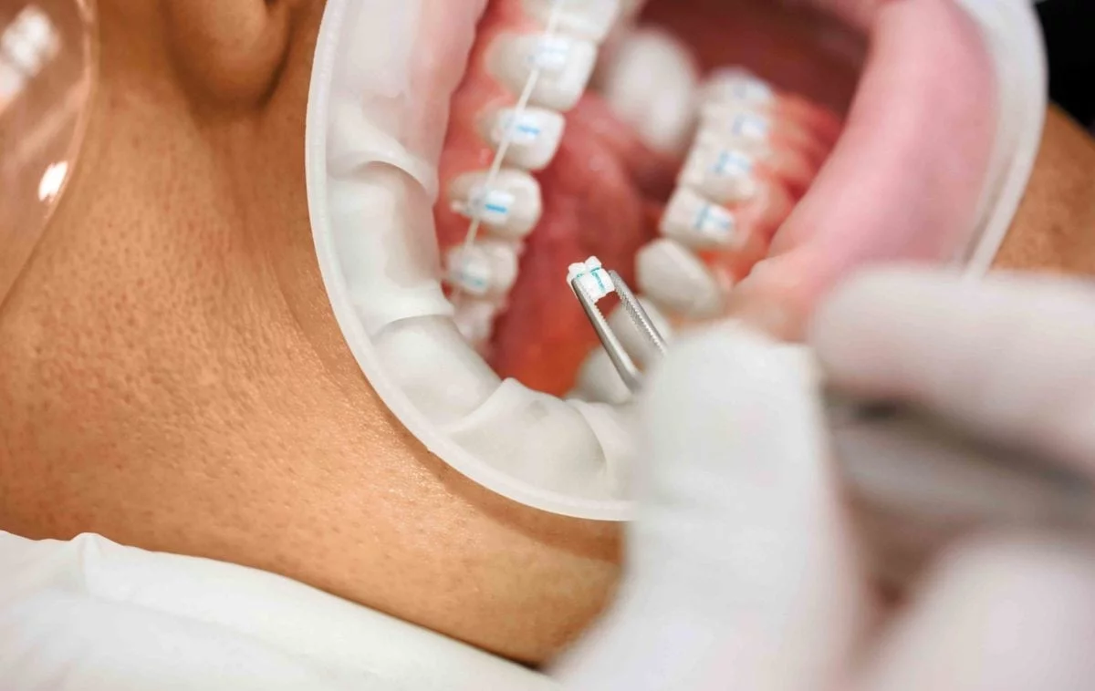 Ceramic Brackets