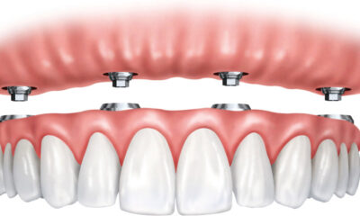Dental Implants