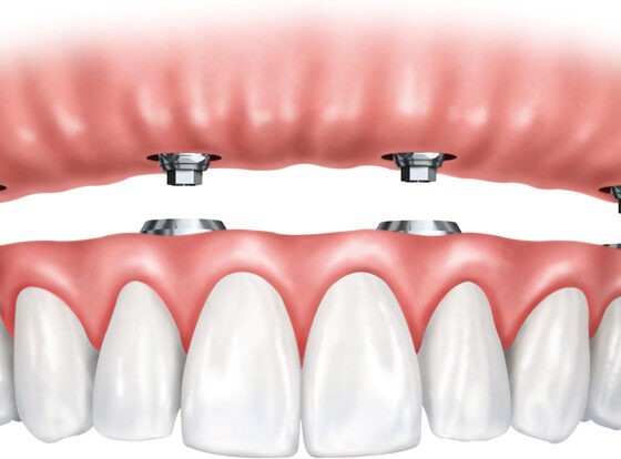 Dental Implants