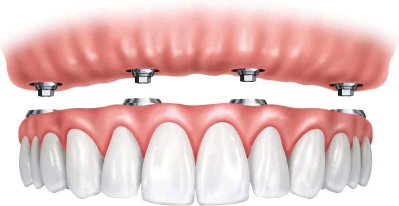 Dental Implants