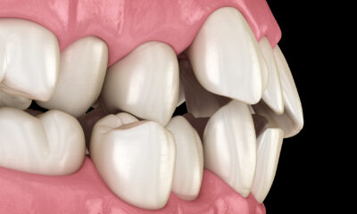 Misaligned Teeth