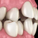 Misaligned Teeth
