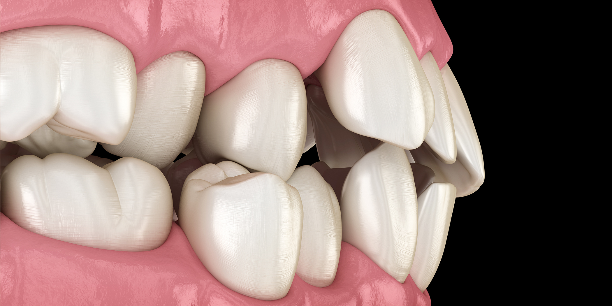 Misaligned Teeth